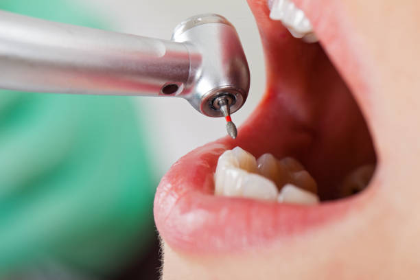 Best Emergency Root Canal Treatment in Red Bank, TN